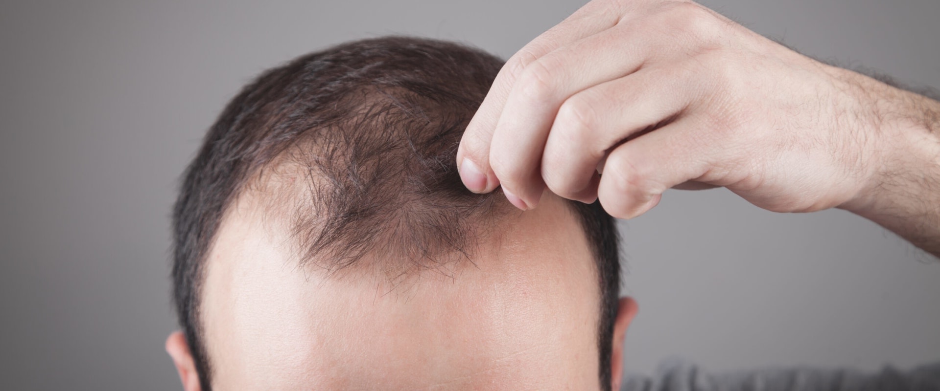 Understanding Thyroid Disorders and Hair Loss
