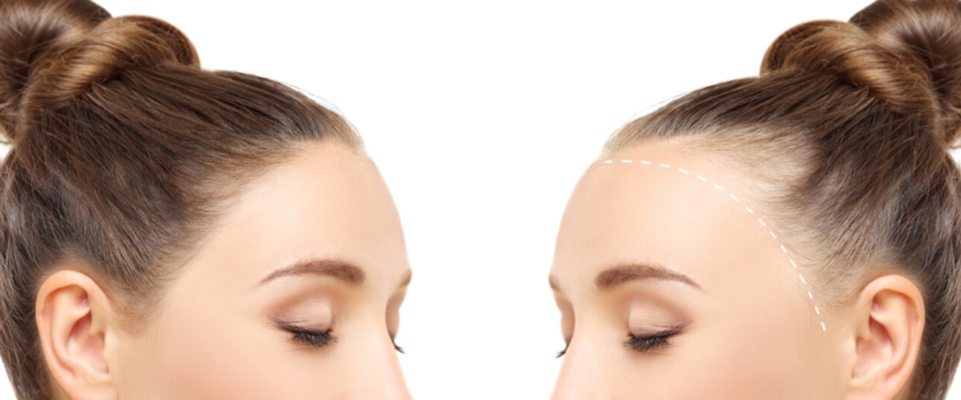Hormonal Imbalances and Hair Loss: Understanding Causes and Solutions