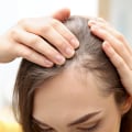 All About Alopecia: Understanding Causes, Prevention, and Treatment