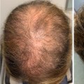 Hair Thickening Sprays: The Ultimate Solution for Preventing Baldness and Hair Loss