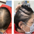 Female Pattern Hair Loss: Understanding the Causes and Solutions