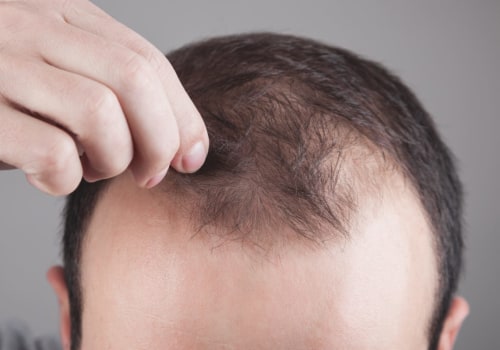 Understanding Thyroid Disorders and Hair Loss