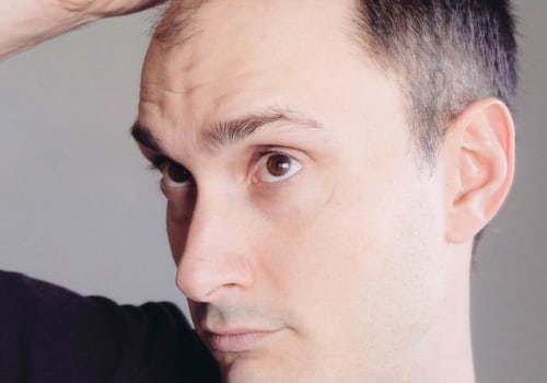 Lifestyle Changes for Preventing Male Pattern Baldness: Essential Tips and Tricks